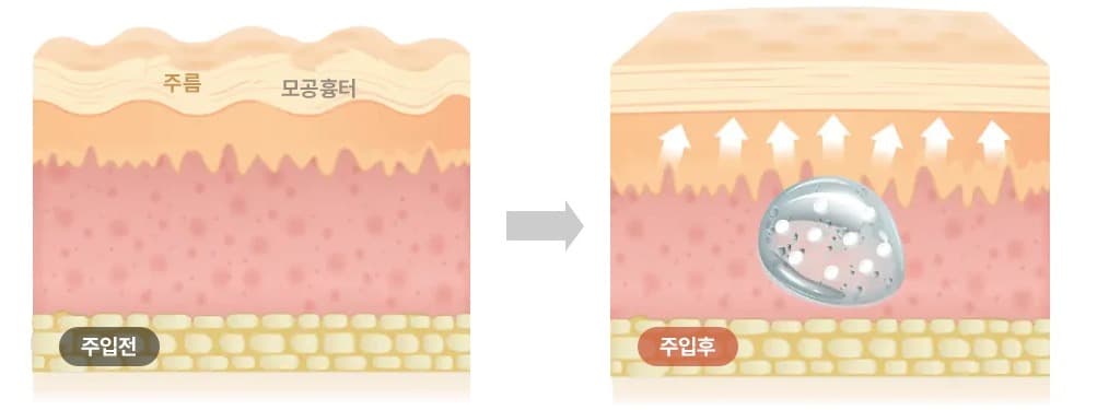 ECM 성분 주입 전(주입전)과 주입 후(주입후) 진피층 변화 일러스트 - 주름·모공 개선