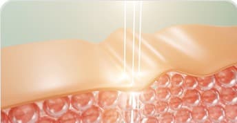 에스테필 특징 - Improved wrinkles and elasticity