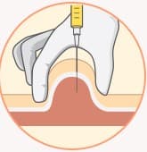 STEP 02 - AestheFill injection