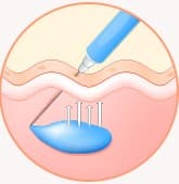STEP 05 - Wrinkle improvement
