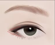 目尻切開の手術の流れ STEP 2 — お一人おひとりの目の形に合わせたデザインを実施