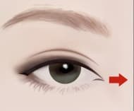 上切開の手術の流れ STEP 2 — お一人おひとりの目の形に合わせたデザインを実施