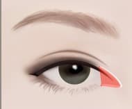 上切開の手術の流れ STEP 3 — 目の内側で蒙古ひだを切開し、不要な皮膚を除去