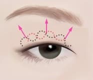 자연유착 쌍꺼풀 수술 과정 03 Surgery 눈매 일러스트