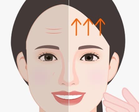 이마·눈썹 리프팅 전후 비교 일러스트 - 처진 눈과 이마 리프팅 후
