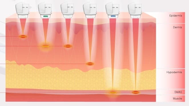 카트리지별 초음파 에너지 전달 피부층 - 표피(Epidermis), 진피(Dermis), 피하(Hypodermis), SMAS층까지 응고존 형성