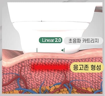 리니어펌 초음파 에너지가 진피층에 응고존을 형성하는 원리 (Linear 2.0 카트리지)