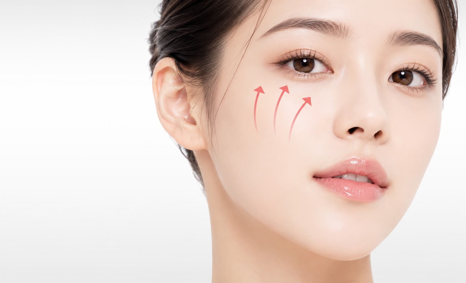 중안면 cheek-up 리프팅 - 처진 앞볼을 위로 끌어올리는 방향을 표시한 얼굴