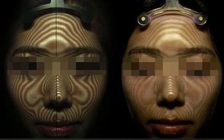 3D 등고선 스캐닝으로 안면 비대칭과 탄력도를 정밀 분석하는 모습