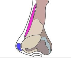 鼻内部の軟骨と挿入した補綴物の位置を示す鼻の構造断面イラスト