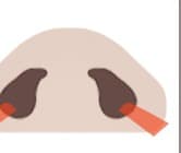 STEP 3 - 小鼻部分の切開