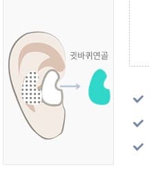 Auricular (ear) cartilage 채취 부위 및 형태 일러스트
