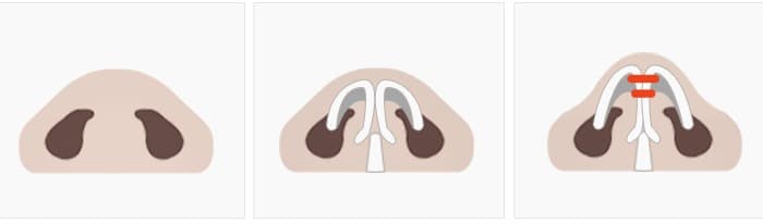 For those whose tip shape is already somewhat defined - 코끝 연골 상태별 수술 단계 다이어그램