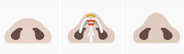 If the tip needs to be raised - 코끝 연골 상태별 수술 단계 다이어그램