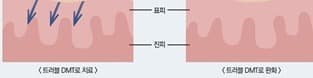 레필레오 트러블 완화 - DMT 시술 전후 피부층(표피·진피) 회복 일러스트