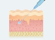 스컬트라 원리 02 - Injected Sculptra fills wrinkles and volume (피부 진피층 변화 일러스트)