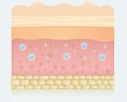 스컬트라 원리 04 - As PLLA breaks down, collagen production is stimulated (피부 진피층 변화 일러스트)