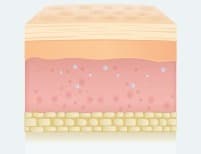 스컬트라 원리 05 - Noticeable results after about 5–6 weeks (피부 진피층 변화 일러스트)