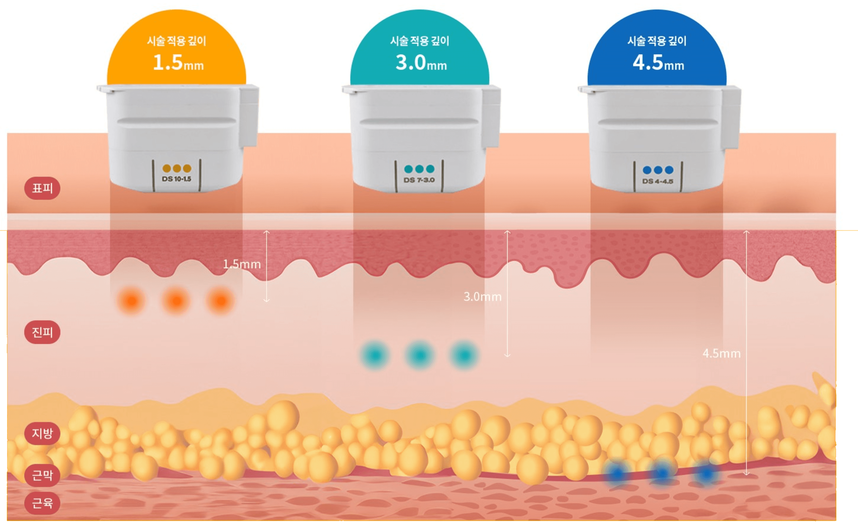 울쎄라피 트랜스듀서별 시술 적용 깊이 - 1.5mm, 3.0mm, 4.5mm